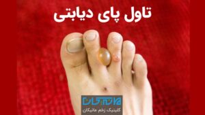 تاول پای دیابتی